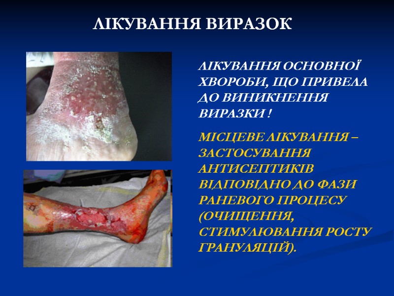 ЛІКУВАННЯ ВИРАЗОК ЛІКУВАННЯ ОСНОВНОЇ ХВОРОБИ, ЩО ПРИВЕЛА ДО ВИНИКНЕННЯ ВИРАЗКИ ! МІСЦЕВЕ ЛІКУВАННЯ – ЛІКУВАННЯ ВИРАЗОК ЛІКУВАННЯ ОСНОВНОЇ ХВОРОБИ, ЩО ПРИВЕЛА ДО ВИНИКНЕННЯ ВИРАЗКИ ! МІСЦЕВЕ ЛІКУВАННЯ –